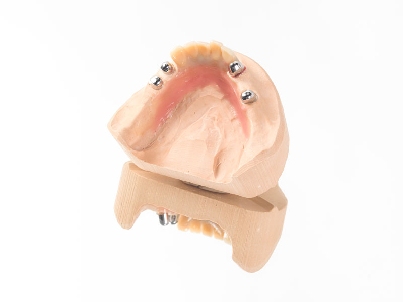 Herausnehmbarer Zahnersatz Modell